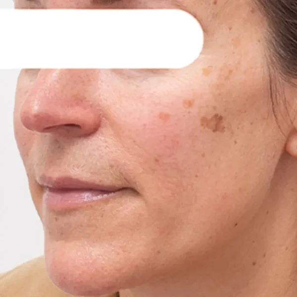 AEXZR® Herbal Spots Peel-Off Facial Mask